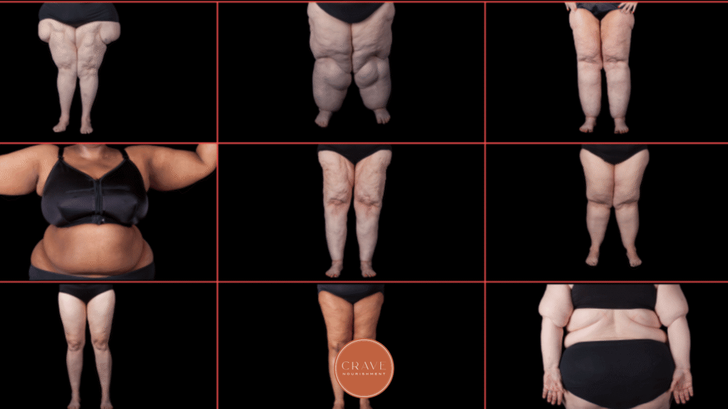 If you've ever felt like your body is working against you, you are not imagining it. Lipedema fat does not behave the same way as typical weight gain, and that difference matters more than most women are ever told. When we understand what is actually happening in the tissue, it becomes much easier to stop blaming ourselves and start focusing on strategies that actually support the body.