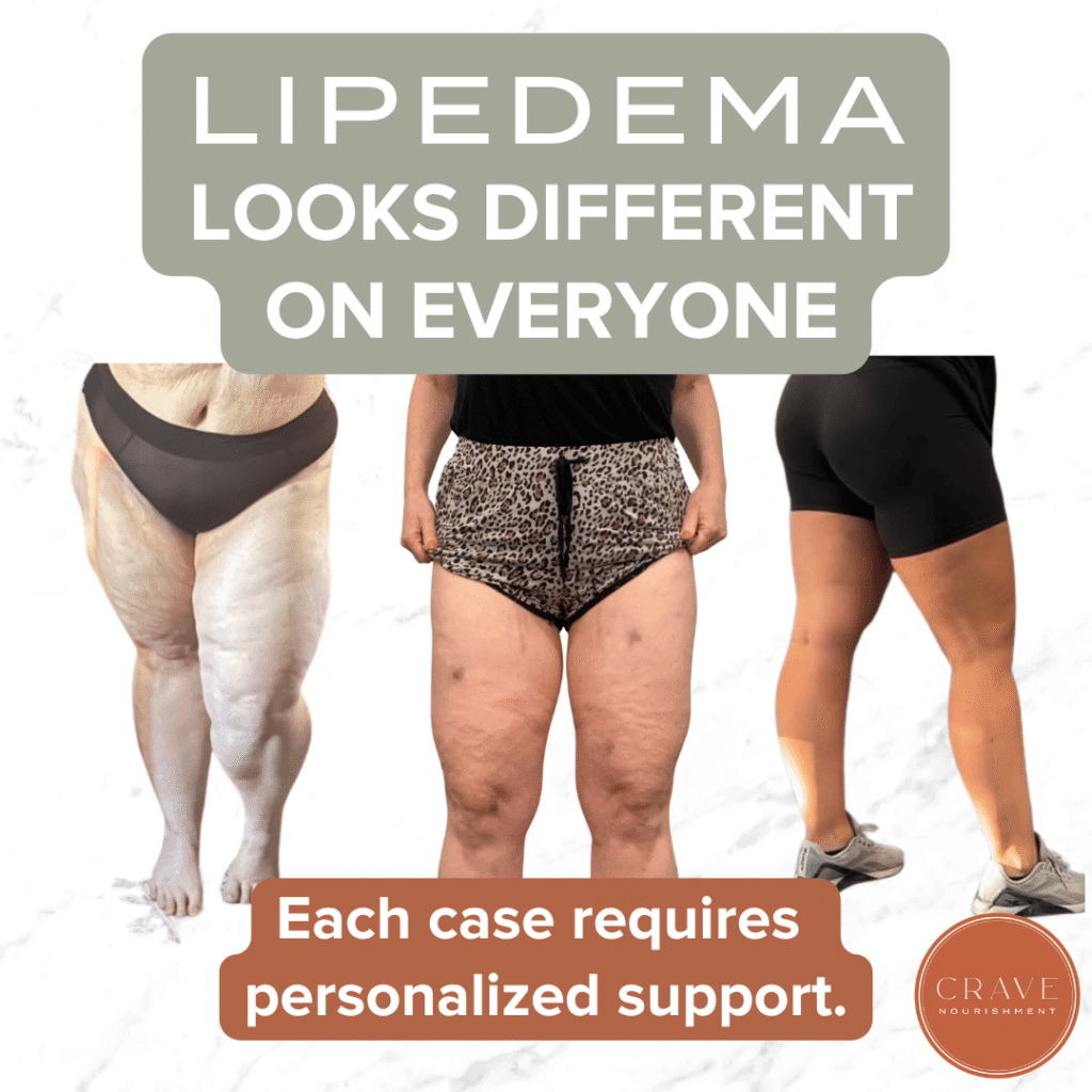 But none of those things mean you don't deserve support. An earlier stage of lipedema does not mean that your emotional experience isn't significant. You may still struggle with body image, swelling, tenderness, chronic inflammatory responses, heaviness, clothing, exercise, or the frustration of knowing that your body is responding differently than you expect it to.